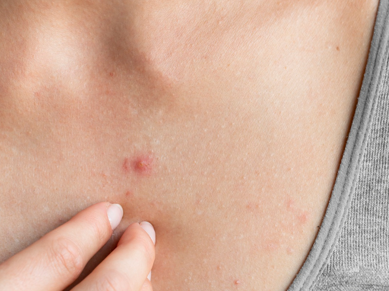What Causes Chest Acne