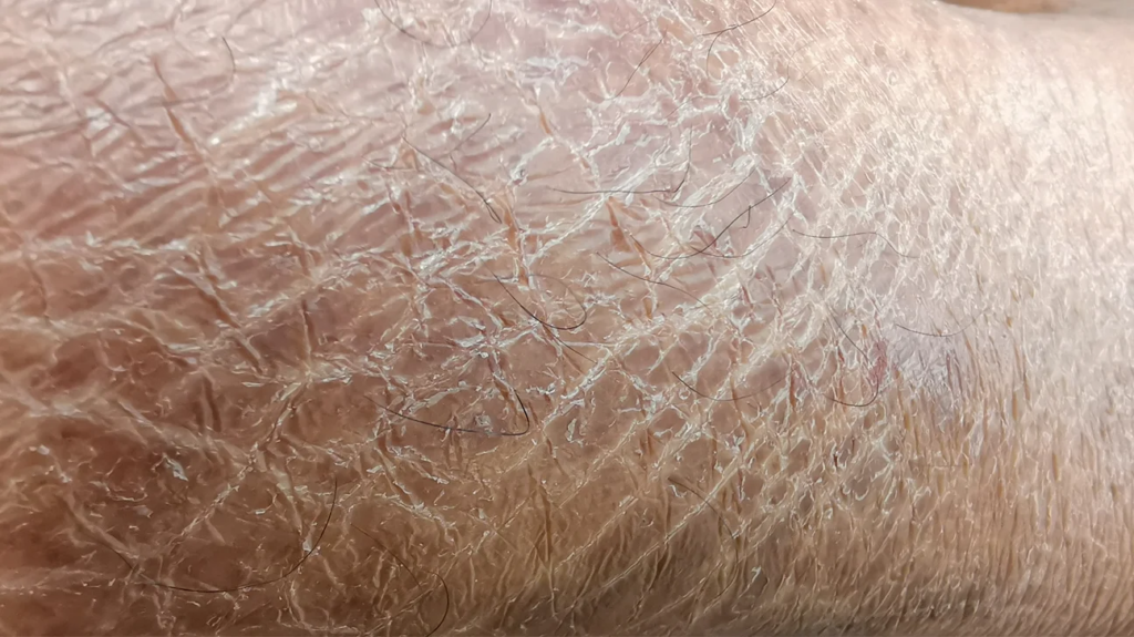 asteatotic eczema images