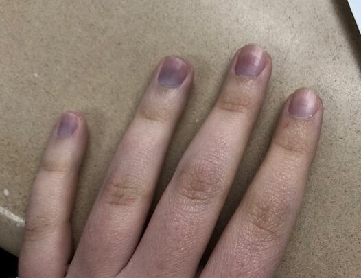 Blue Fingernails causes