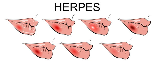 cold sore stages illustration