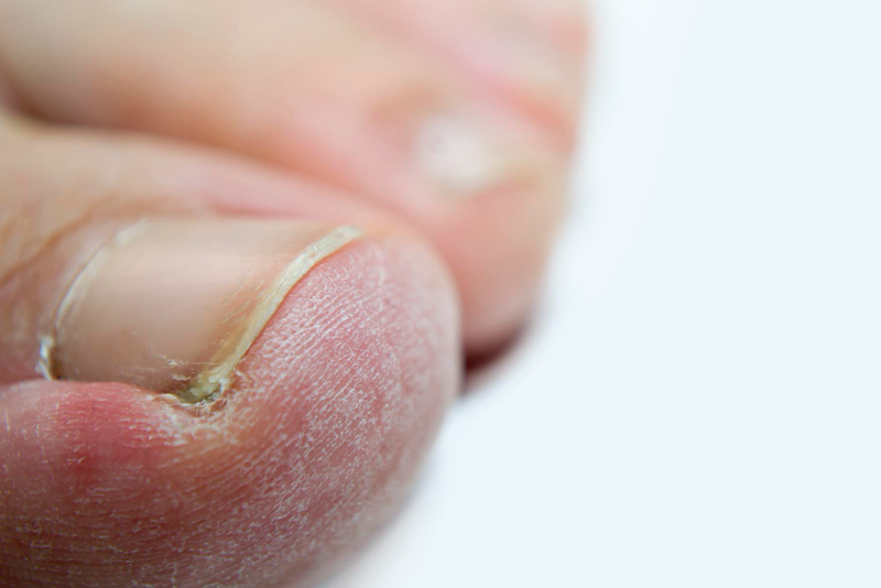 early stage nail fungus images