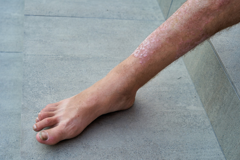 online Psoriasis Treatment
