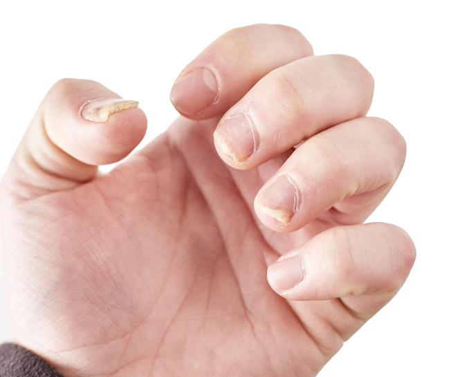 what causes brittle nails