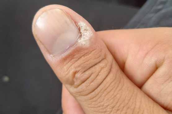 What Are Periungual Warts