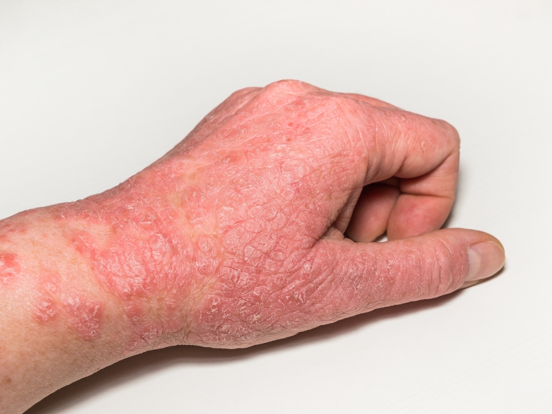 Hand Eczema Symptoms