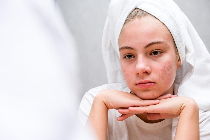 Hormonal acne caused by puberty