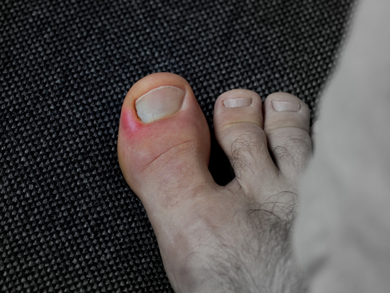 Paronychia treatment self-care