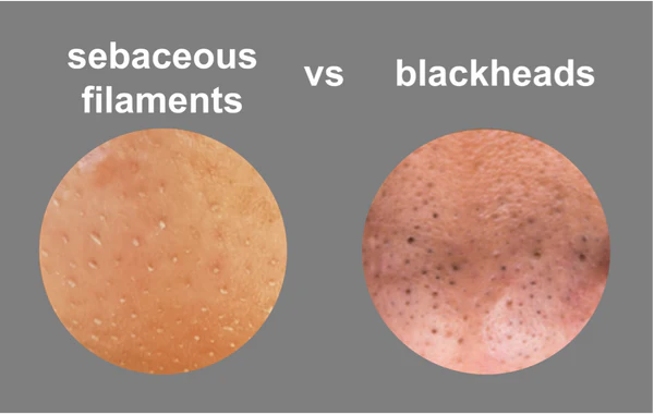 Sebaceous filaments vs blackheads