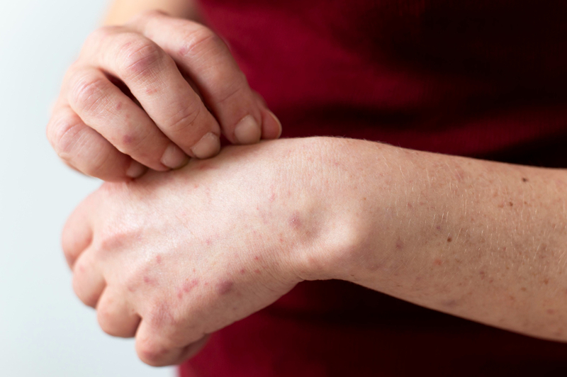 Causes of Eczema on hand