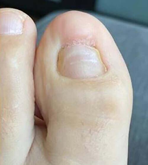 Disappearing Nail Bed symptom