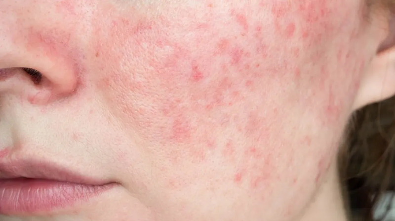 Facial redness Rosacea symptoms