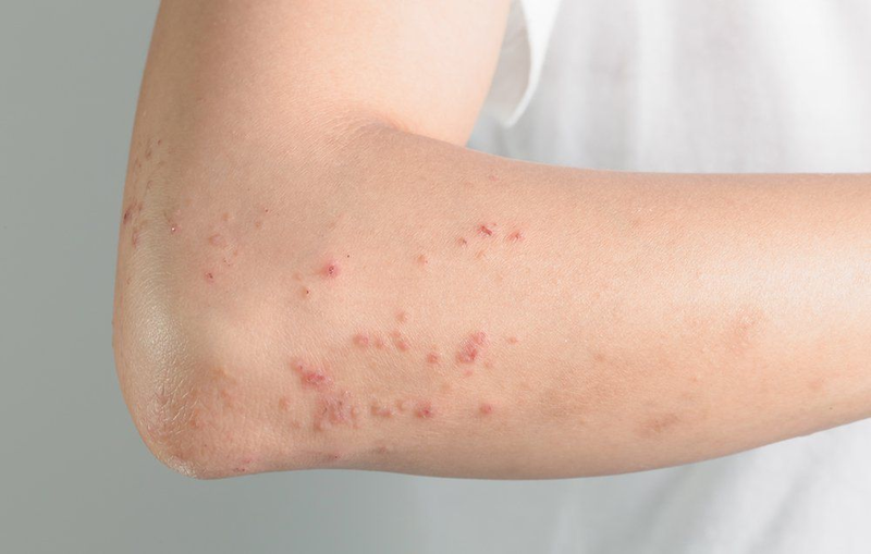 Hives triggered by external factors