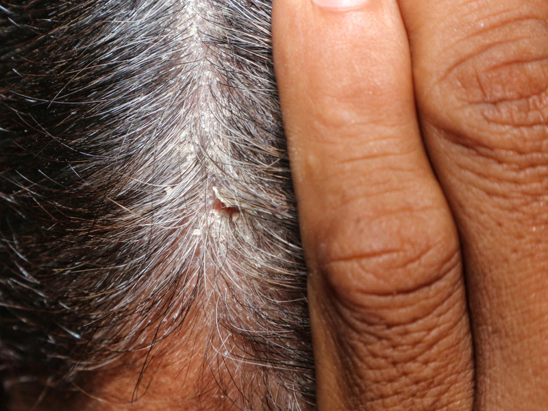Scalp Conditions Cause Scalp Pain