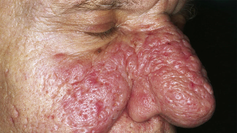 Rhinophyma symptoms