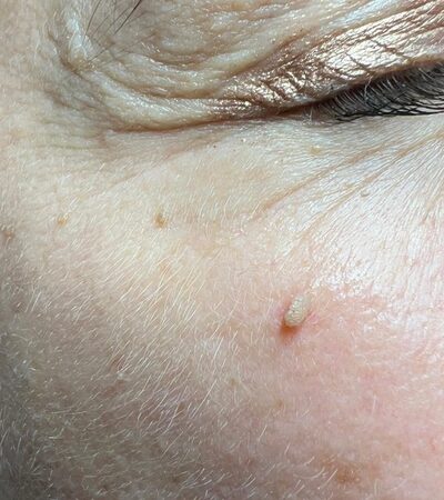 Symptoms of filiform warts